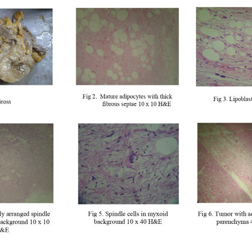 Rare Tumor at Rare site