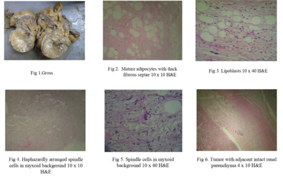 Rare Tumor at Rare site